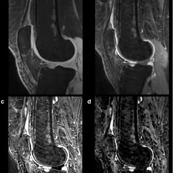 MRI Left Knee With Contrast
